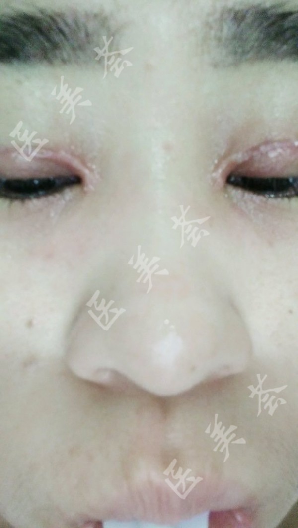 双眼皮术后疤痕增生图