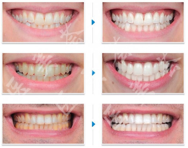 牙齿美白前后对比照片图片
