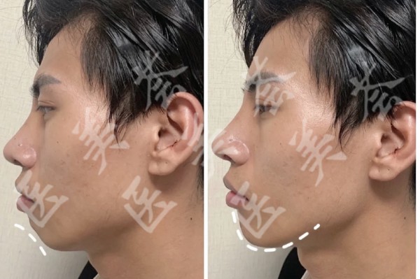 男士下巴后缩图
